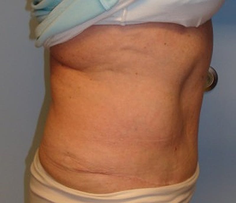 Tummy Tuck Before & After