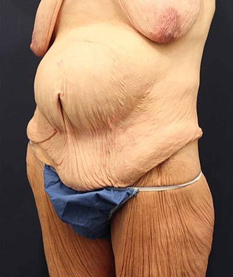 Tummy Tuck Before & After