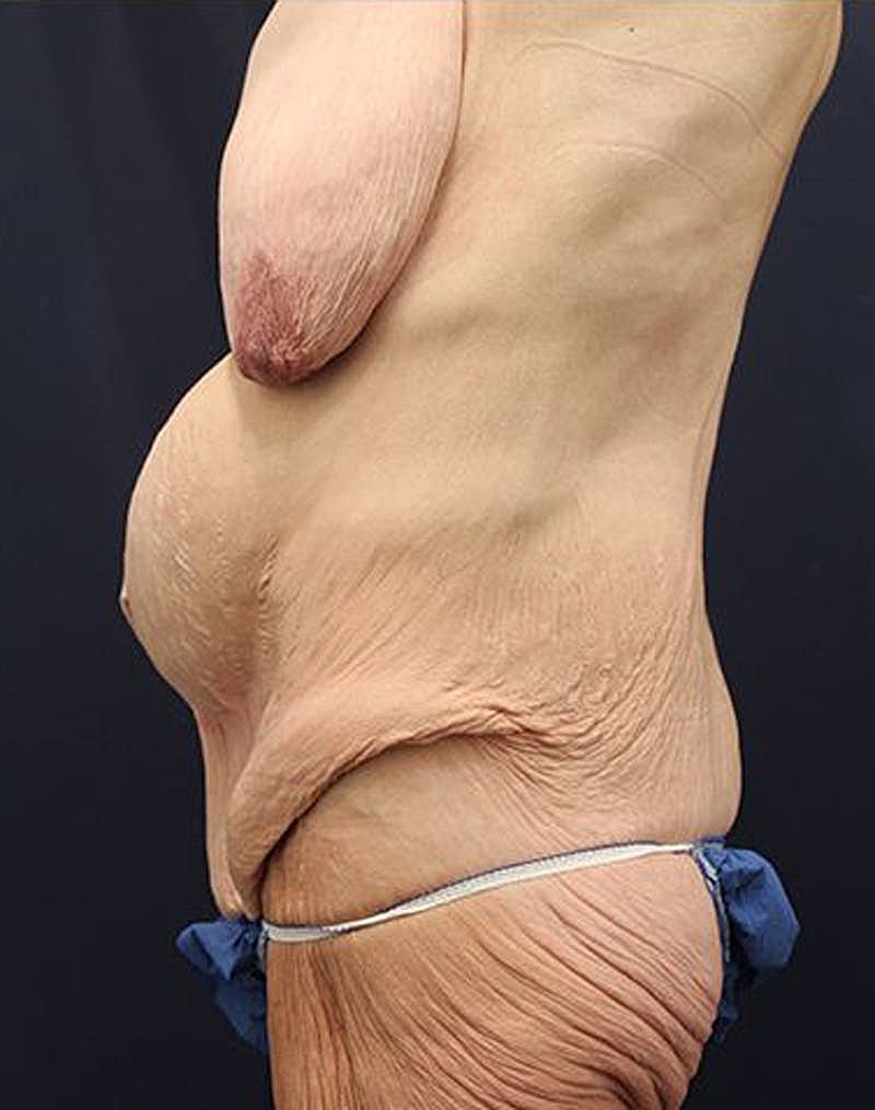 Tummy Tuck Before & After