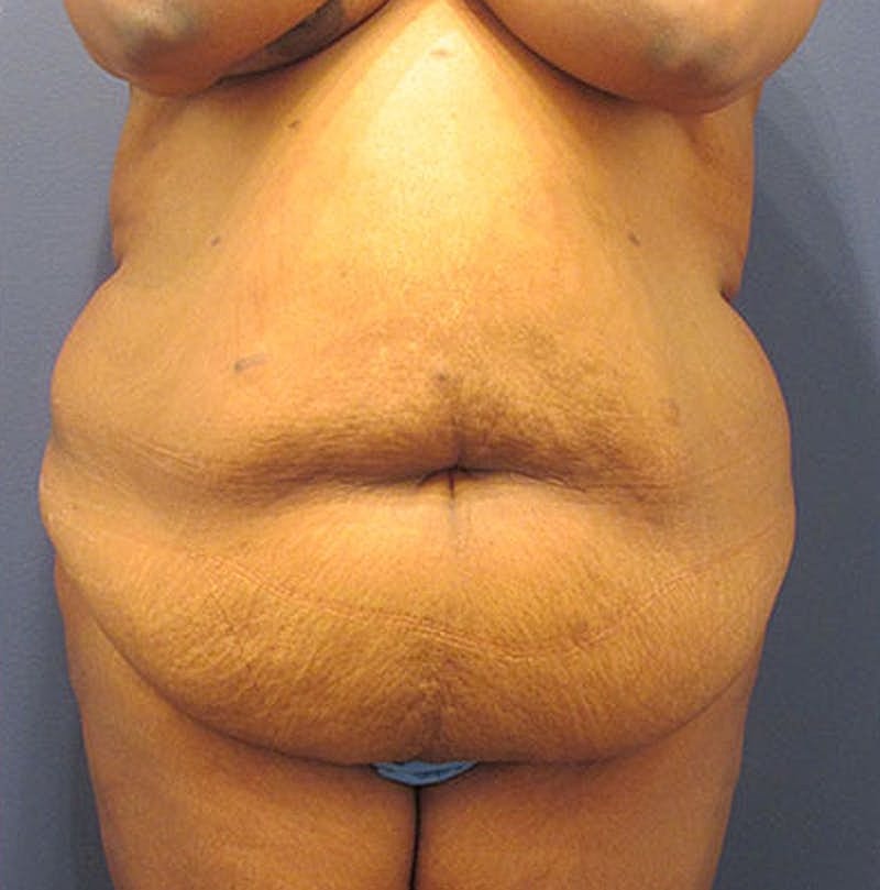 Tummy Tuck Before & After