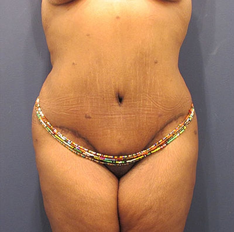Tummy Tuck Before & After