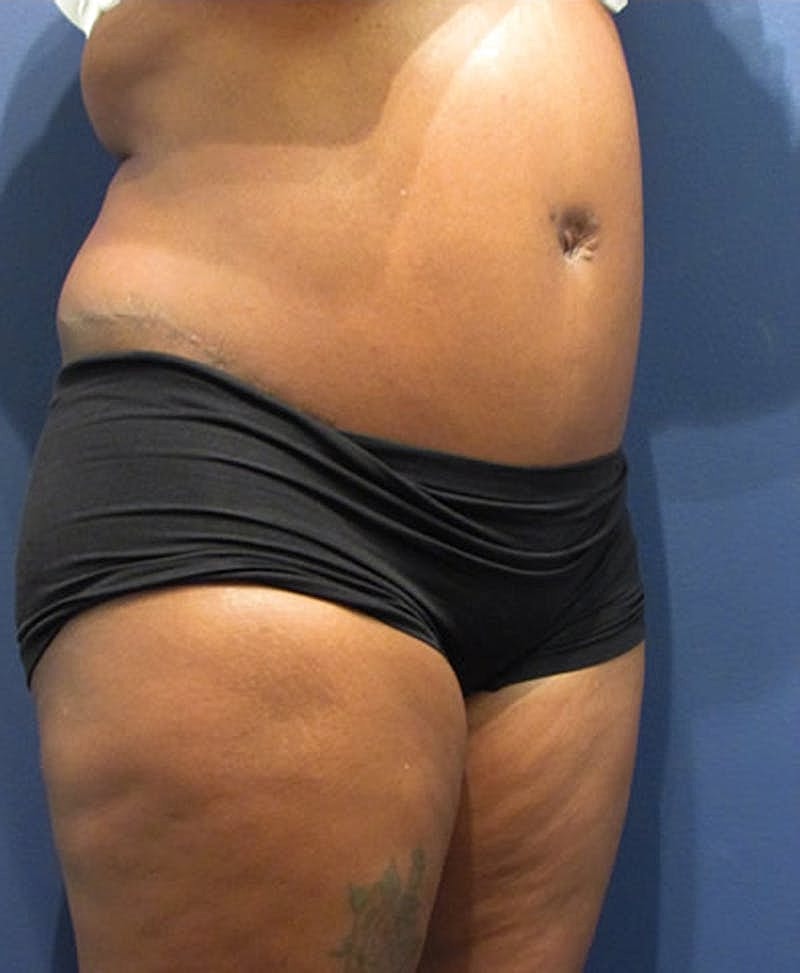 Tummy Tuck Before & After