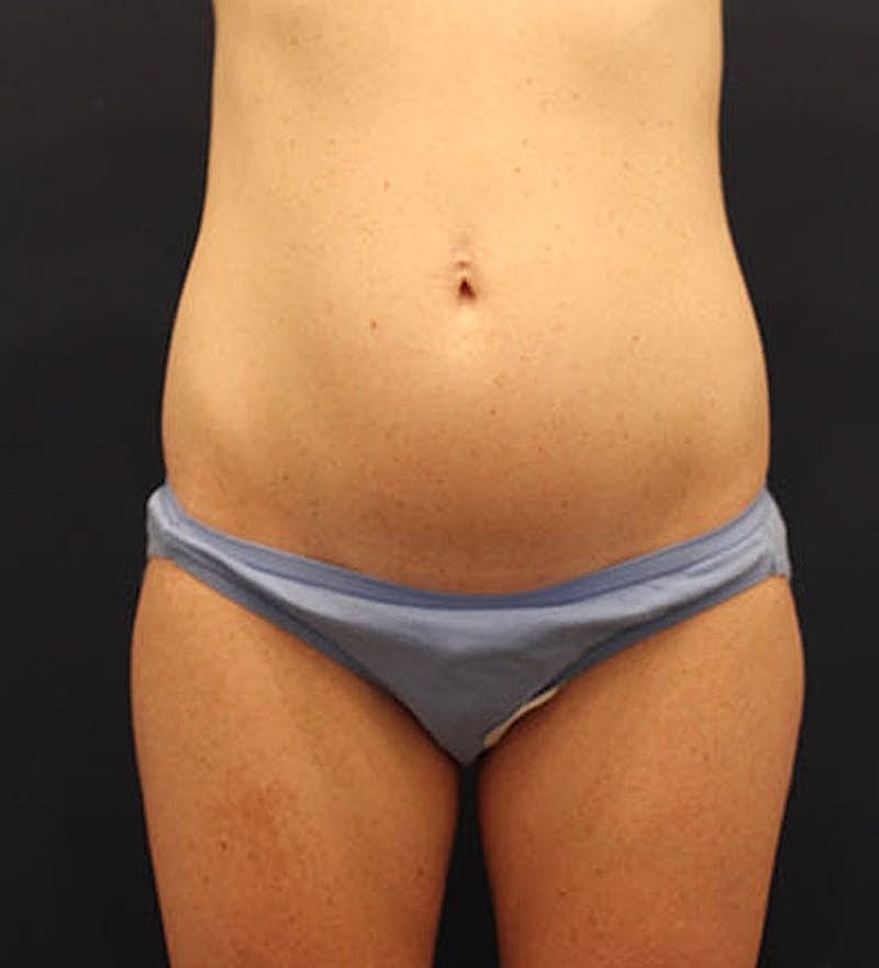 Tummy Tuck Before & After