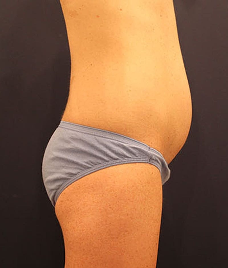 Tummy Tuck Before & After