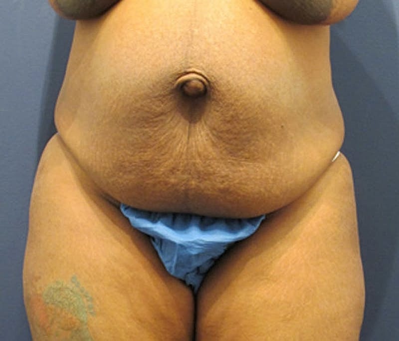 Tummy Tuck Before & After