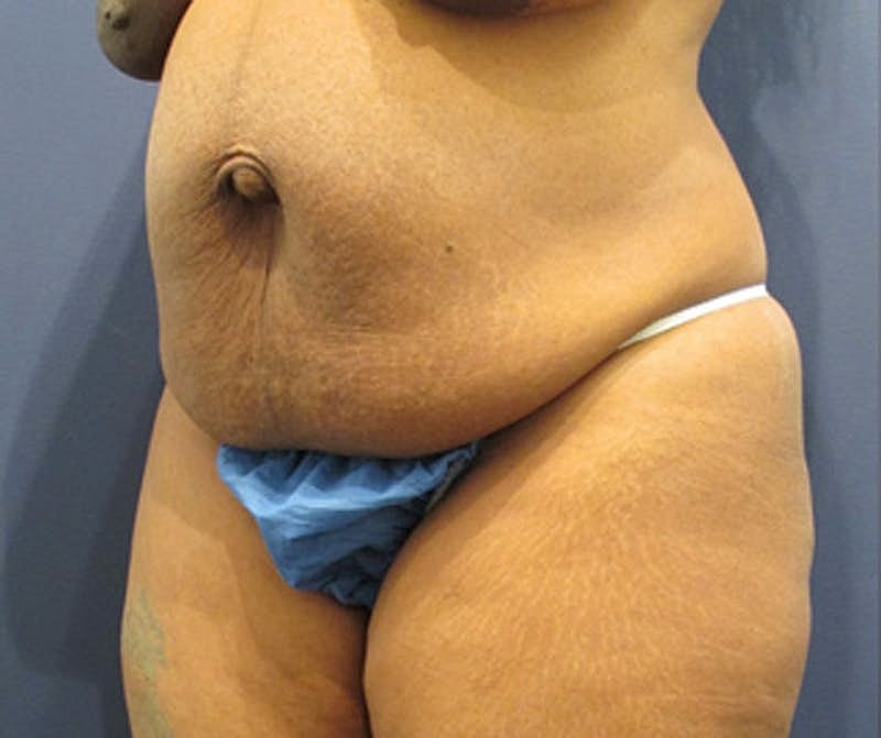 Tummy Tuck Before & After