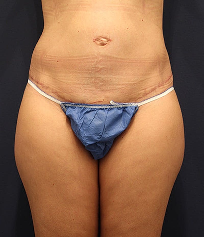 Tummy Tuck Before & After