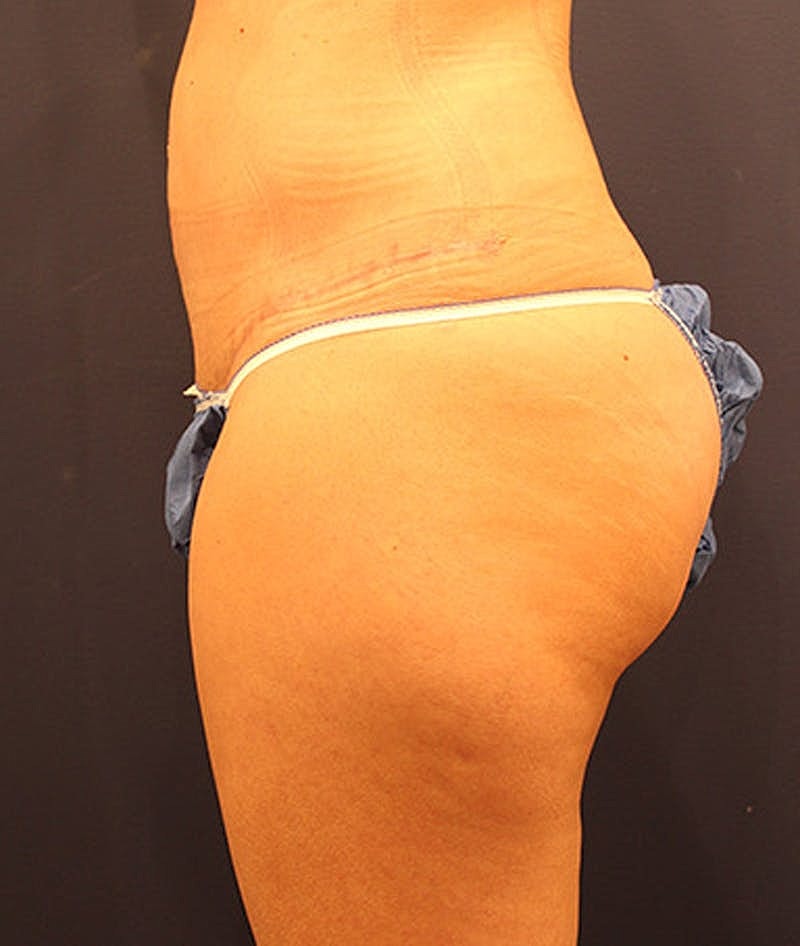 Tummy Tuck Before & After