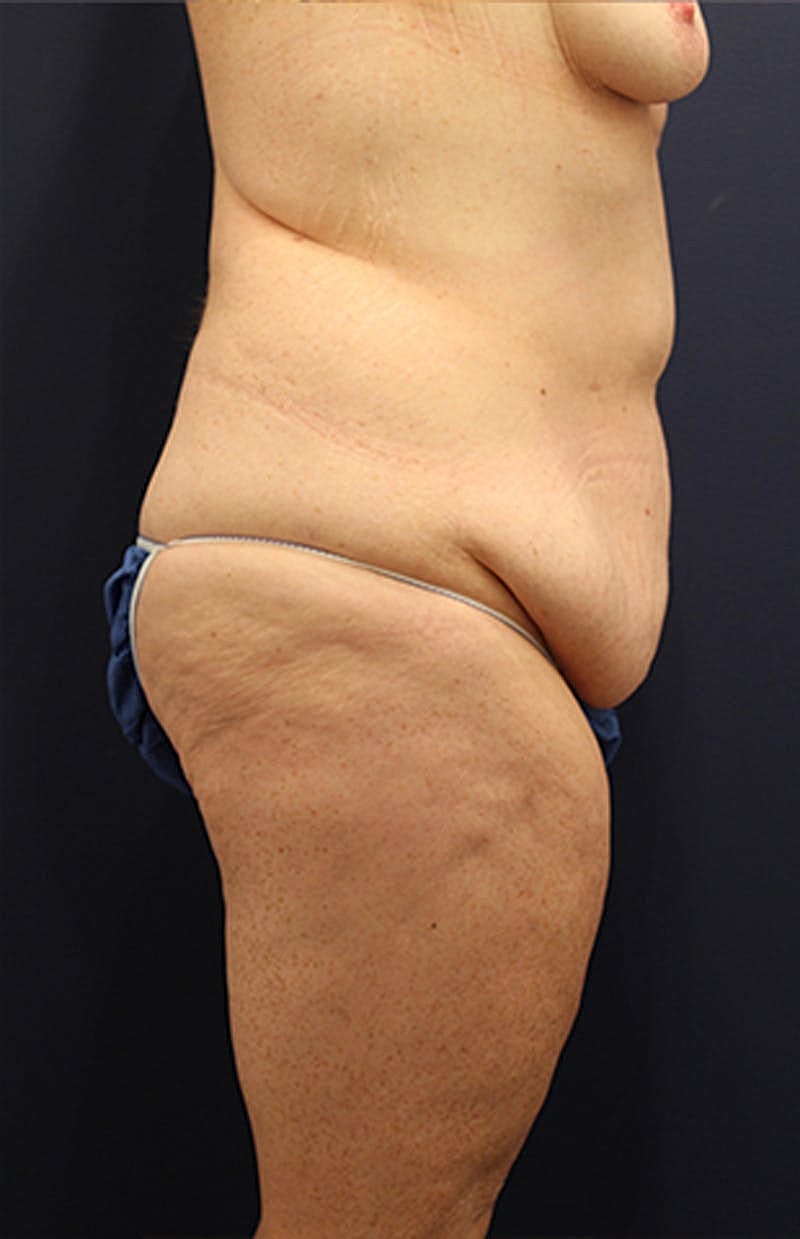 Tummy Tuck Before & After