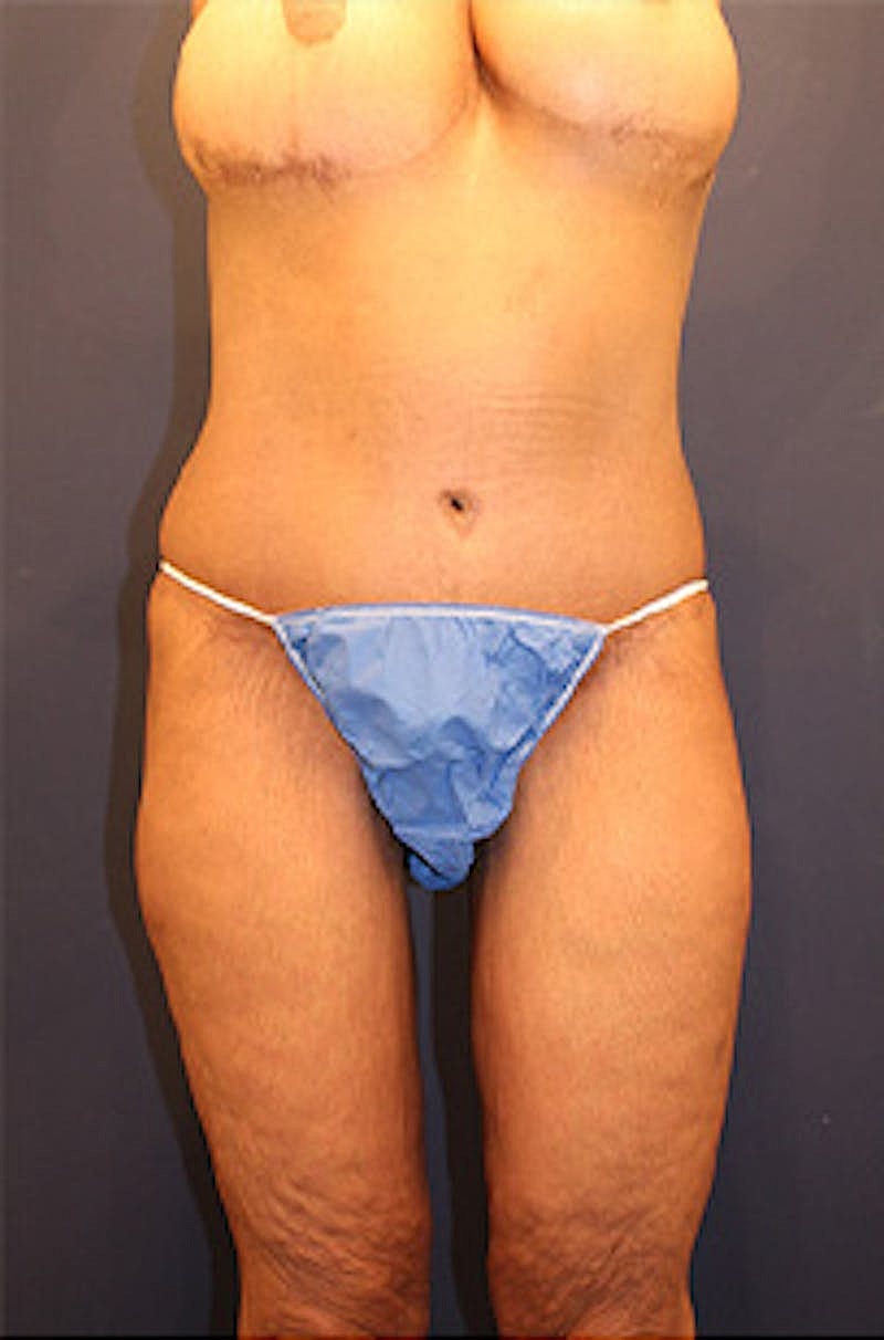 Tummy Tuck Before & After