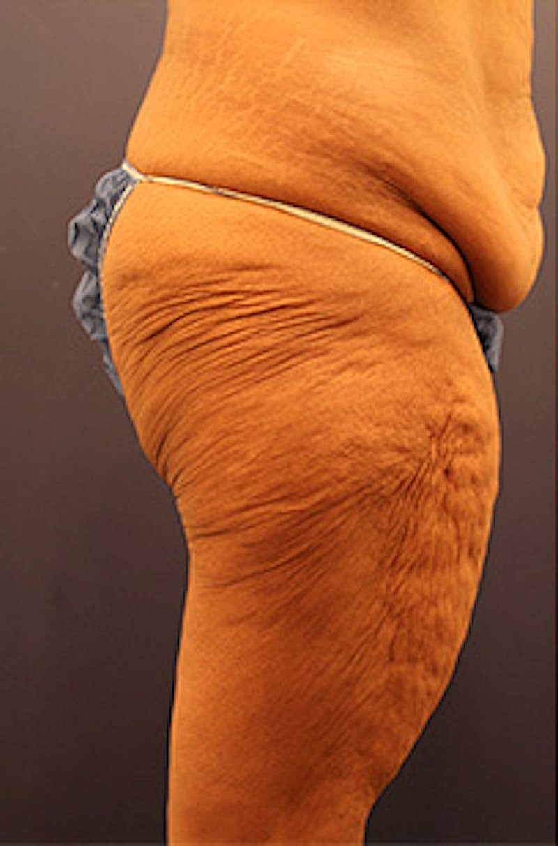 Tummy Tuck Before & After