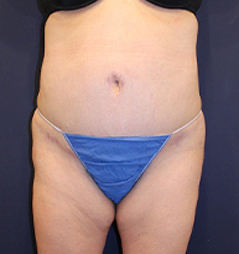 Tummy Tuck Before & After