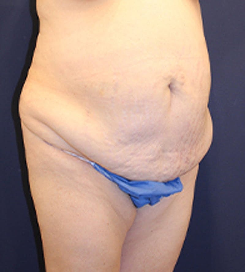 Tummy Tuck Before & After