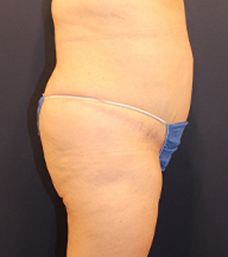 Tummy Tuck Before & After