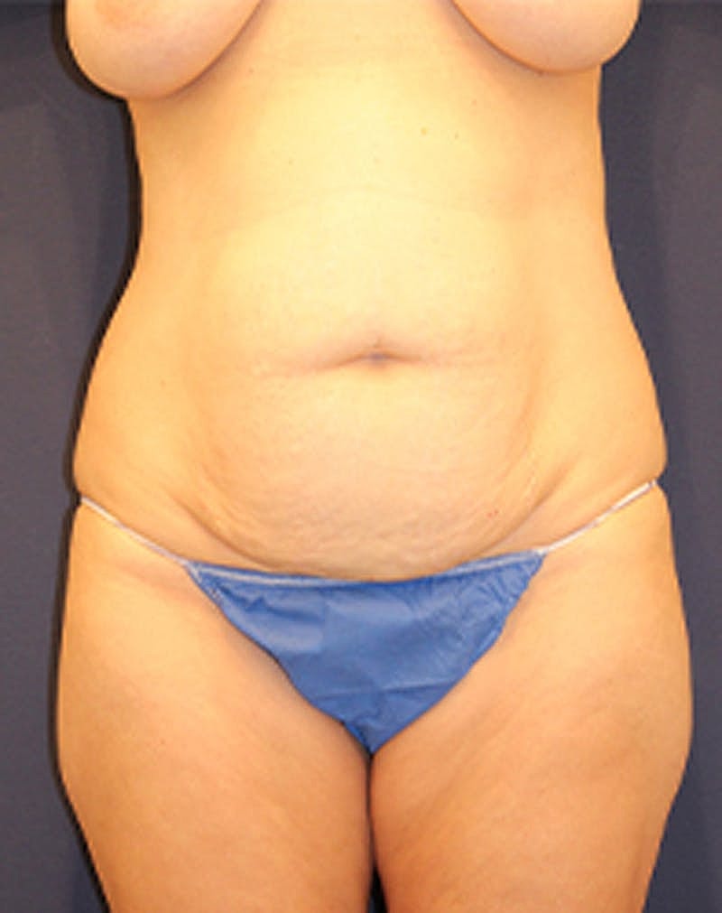 Tummy Tuck Before & After