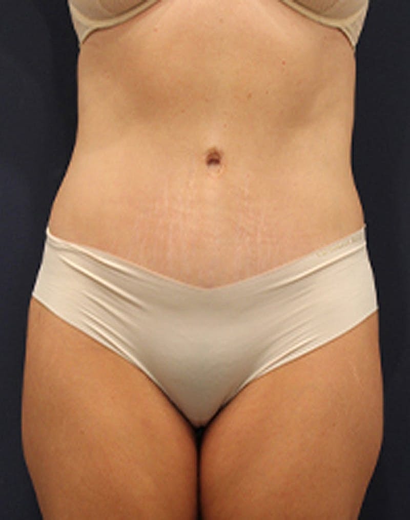 Tummy Tuck Before & After