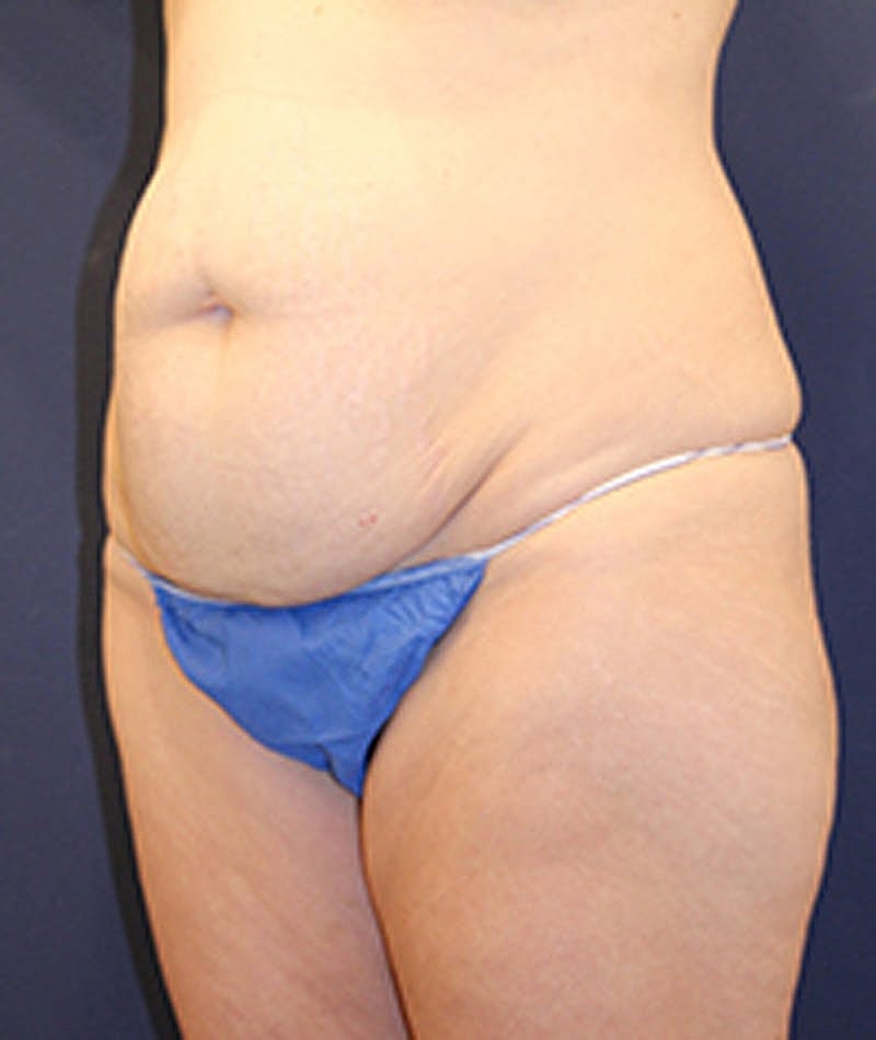 Tummy Tuck Before & After