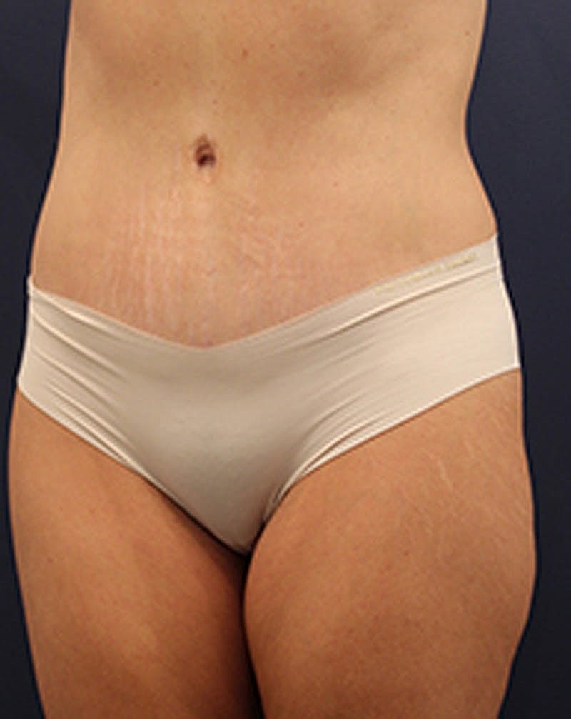 Tummy Tuck Before & After