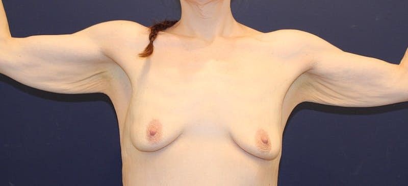 Arm Lift Before & After