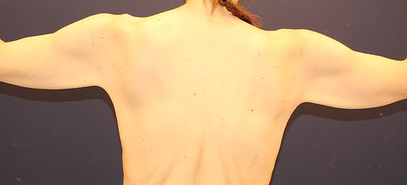 Arm Lift Before & After