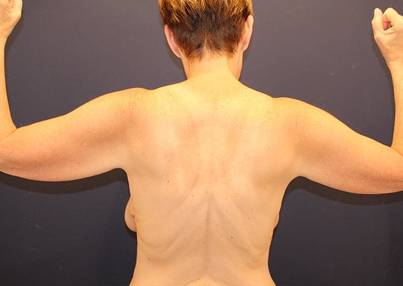 Arm Lift Before & After