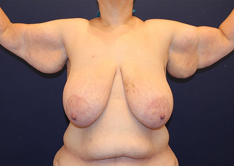 Arm Lift Before & After