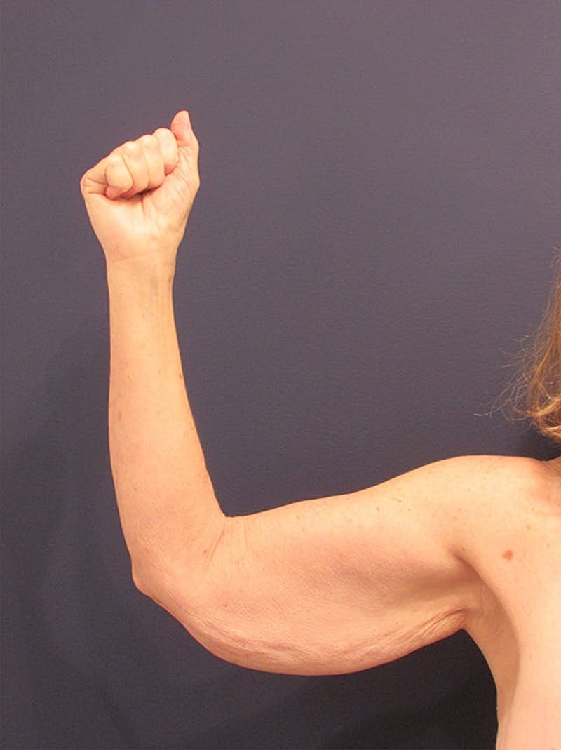 Arm Lift Before & After