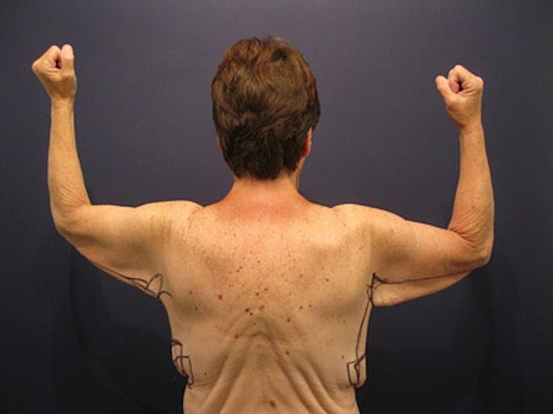 Arm Lift Before & After