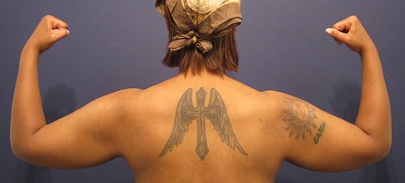 Arm Lift Before & After