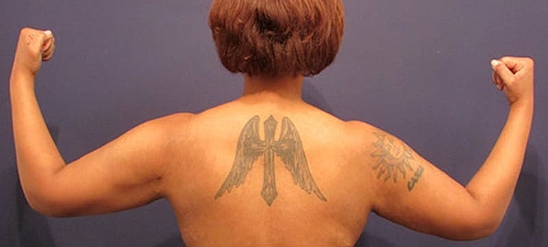 Arm Lift Before & After