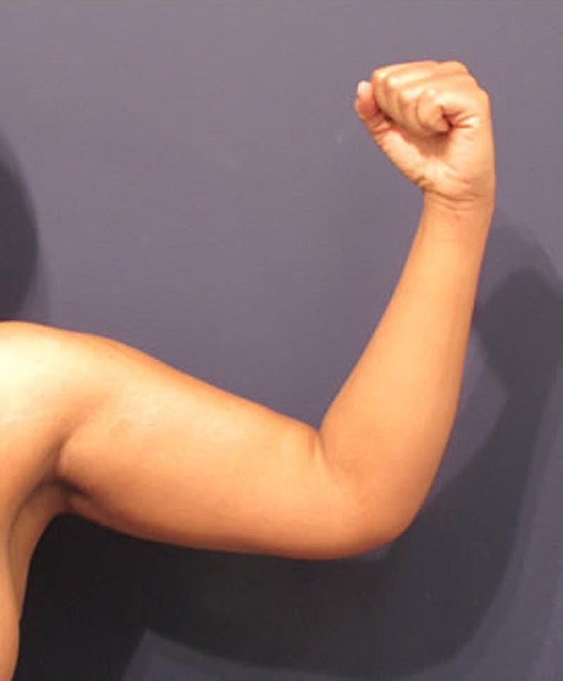 Arm Lift Before & After