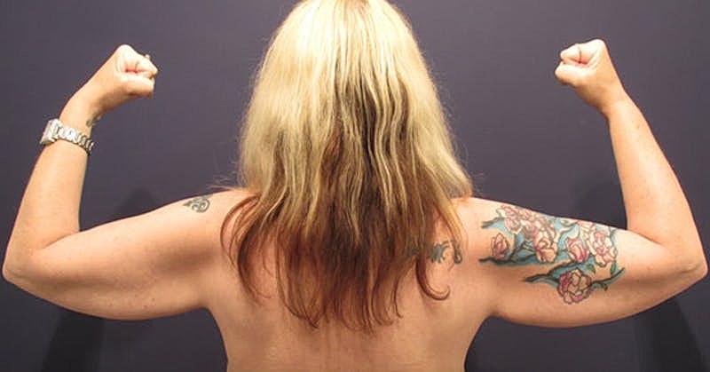 Arm Lift Before & After