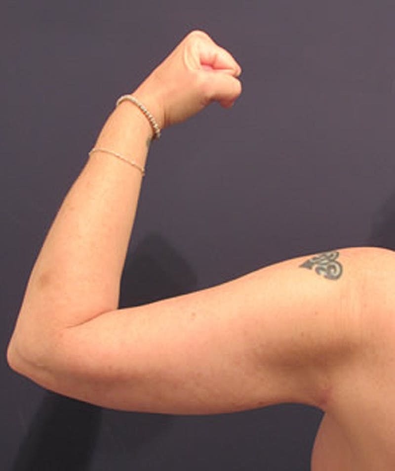 Arm Lift Before & After