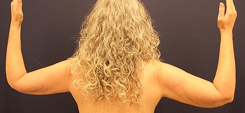 Arm Lift Before & After