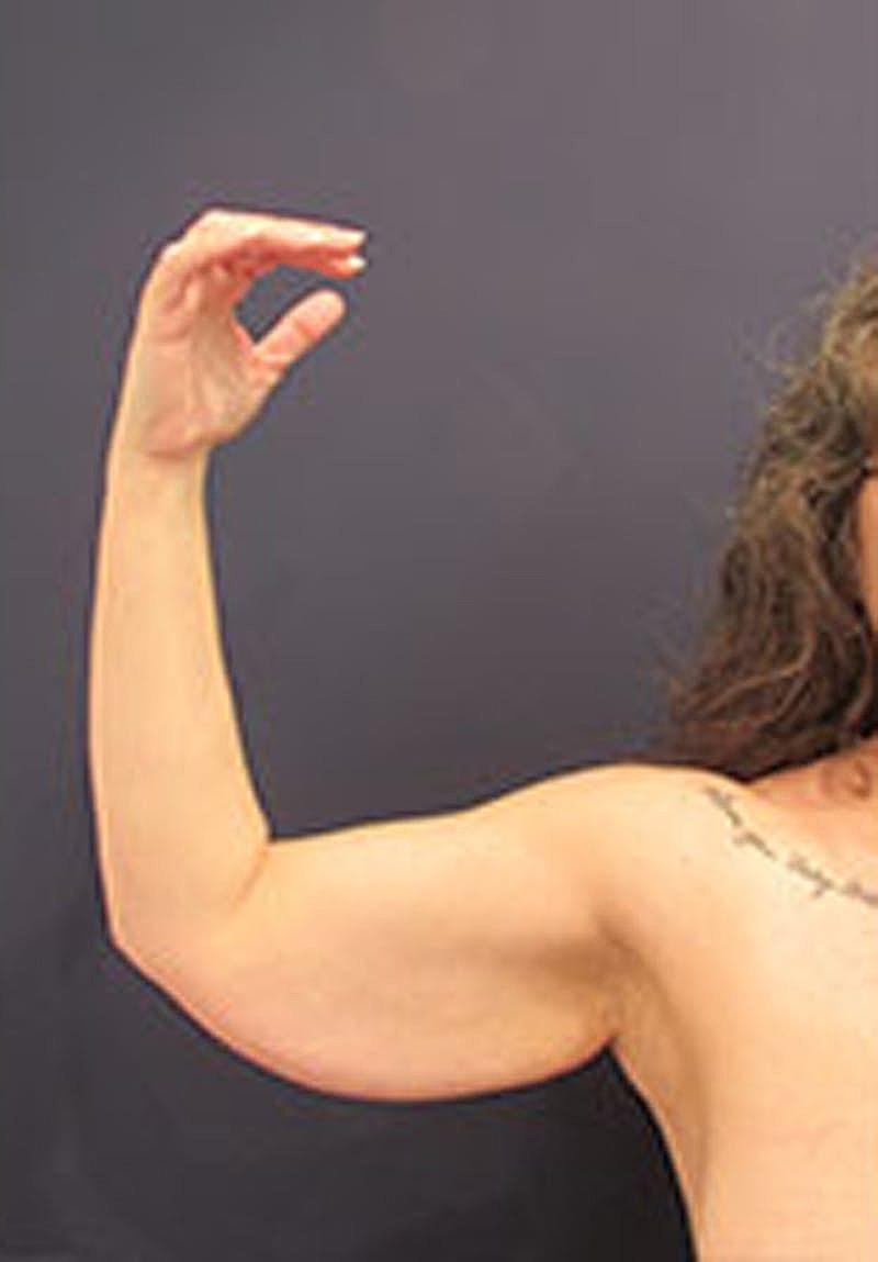 Arm Lift Before & After