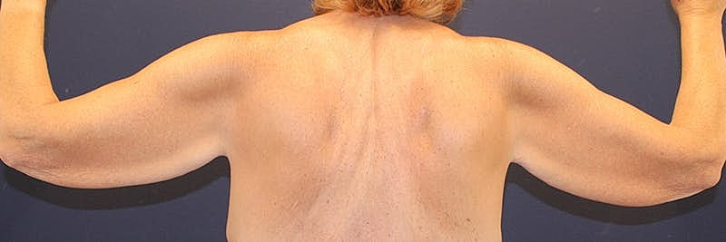 Arm Lift Before & After