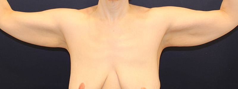 Arm Lift Gallery Before & After