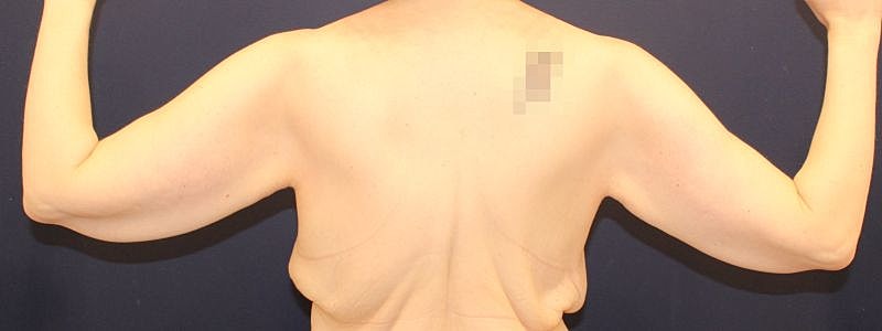 Arm Lift Gallery Before & After