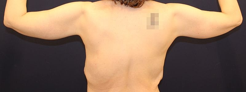 Arm Lift Gallery Before & After