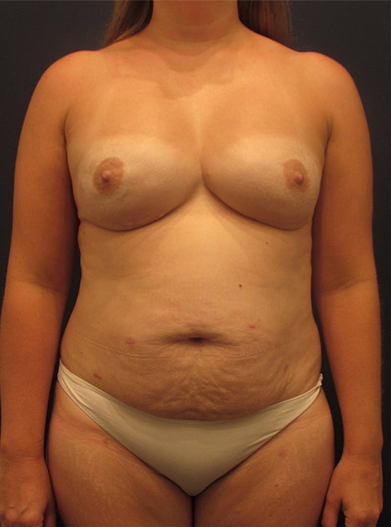 Breast Reconstruction Before & After