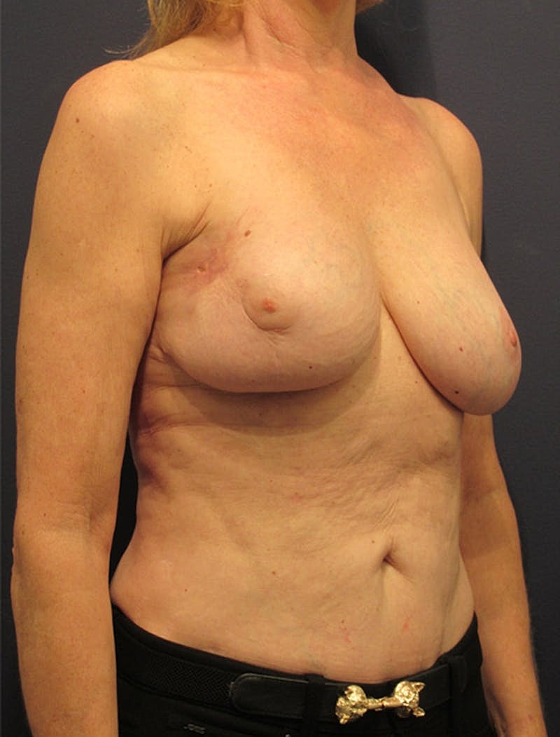 Breast Reconstruction Before & After