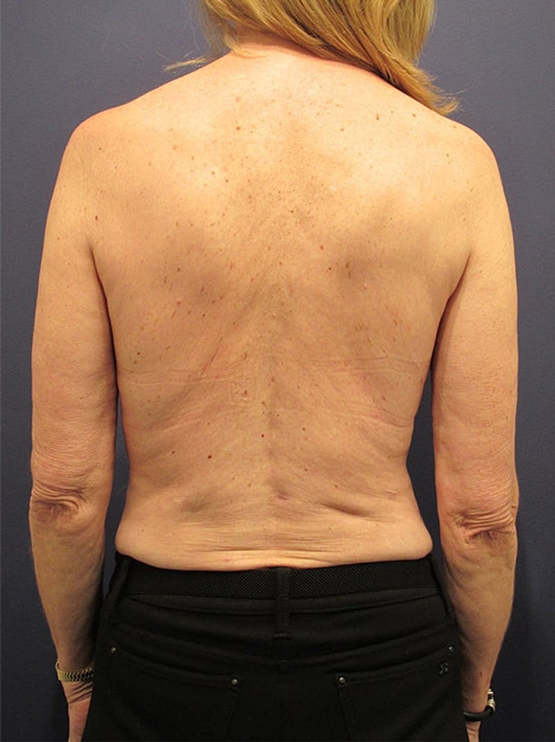 Breast Reconstruction Before & After