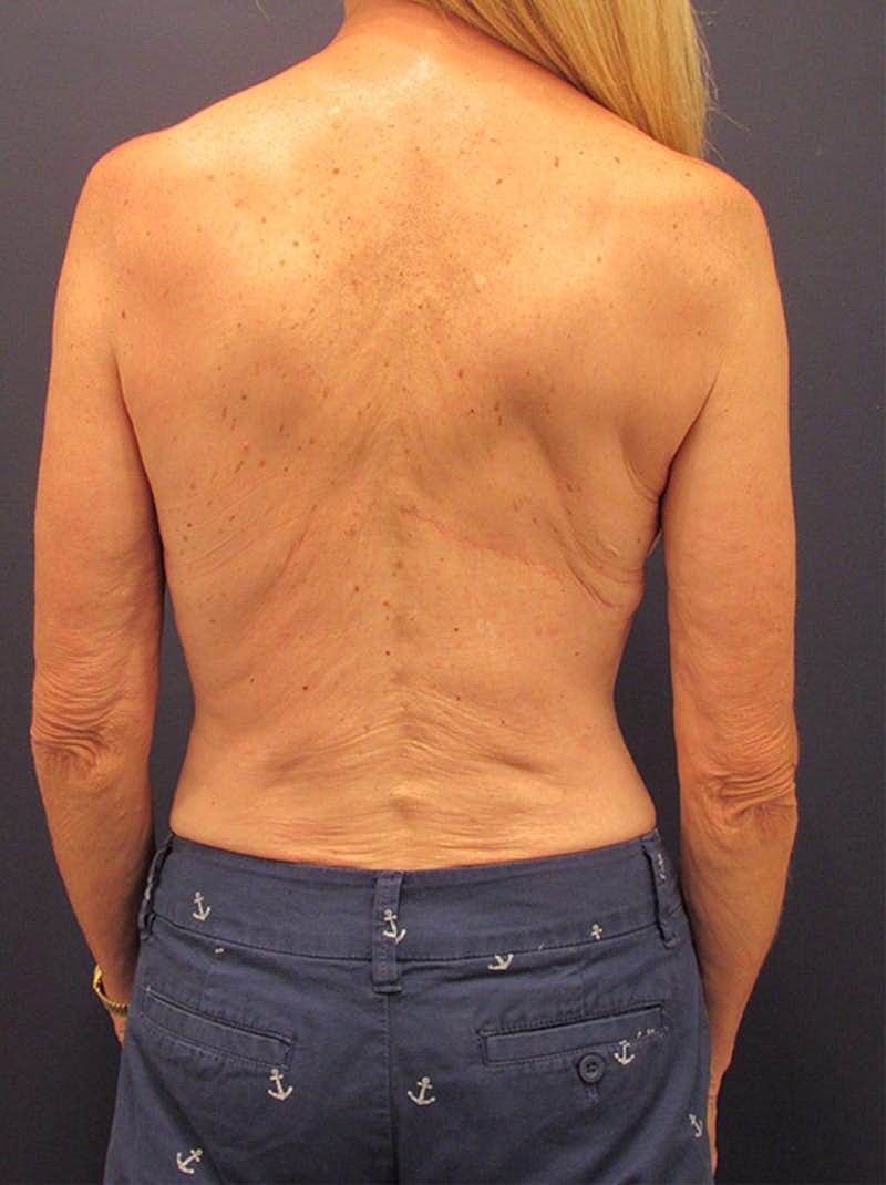 Breast Reconstruction Before & After