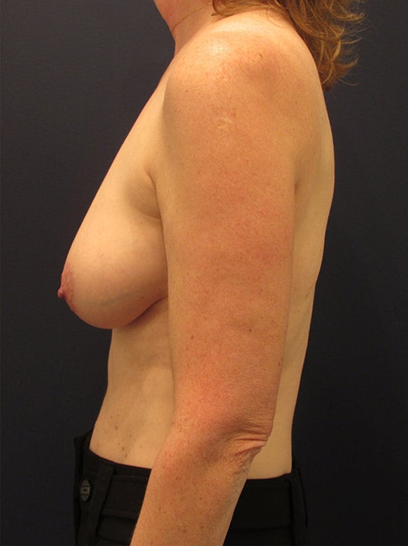 Breast Reconstruction Before & After