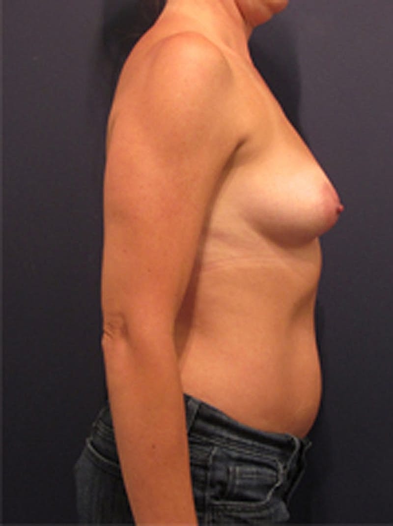 Breast Reconstruction Before & After