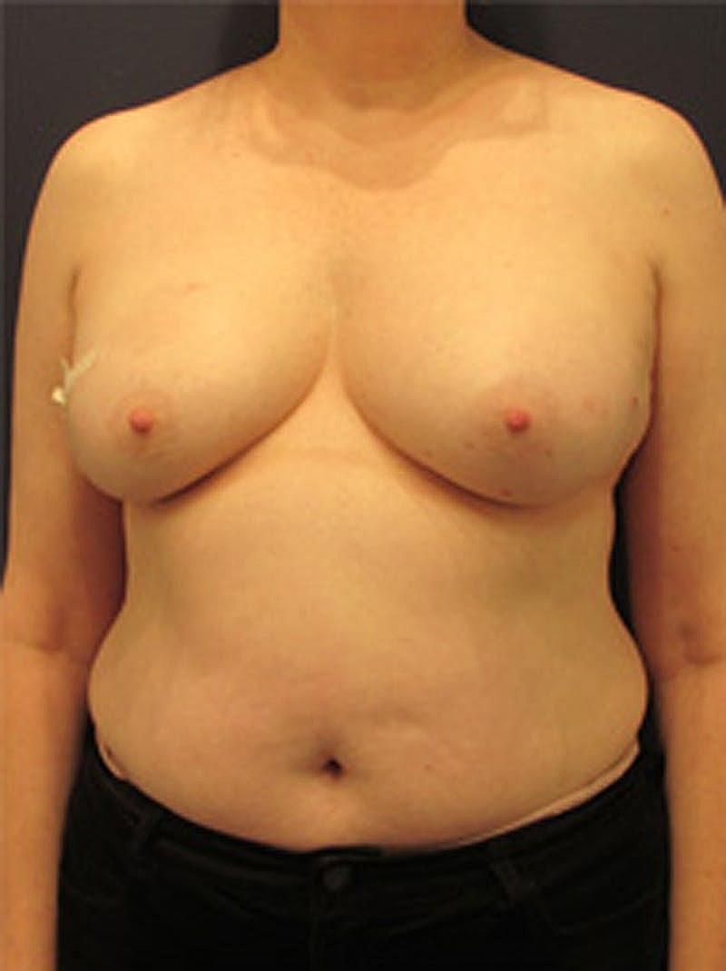 Breast Reconstruction Before & After
