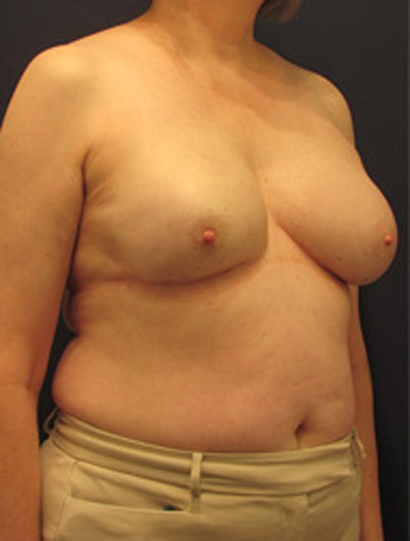 Breast Reconstruction Before & After