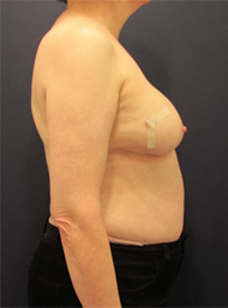 Breast Reconstruction Before & After