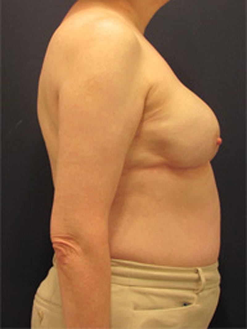 Breast Reconstruction Before & After