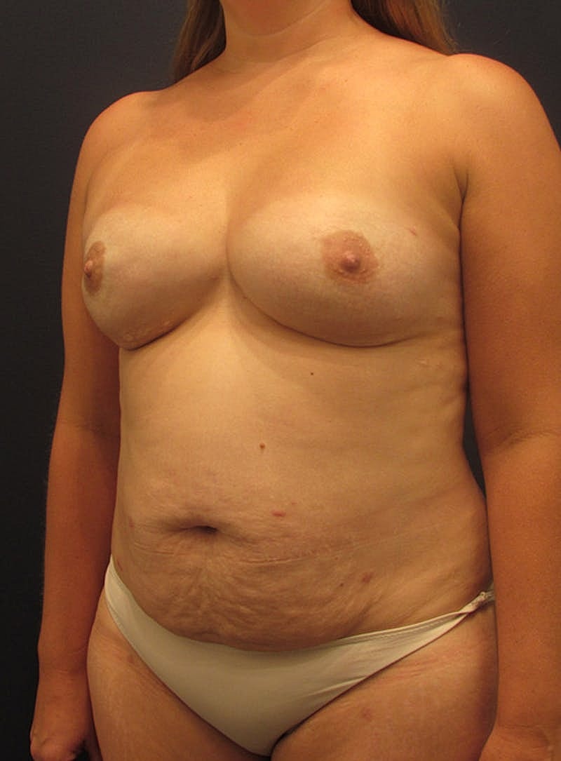 Breast Reconstruction Before & After